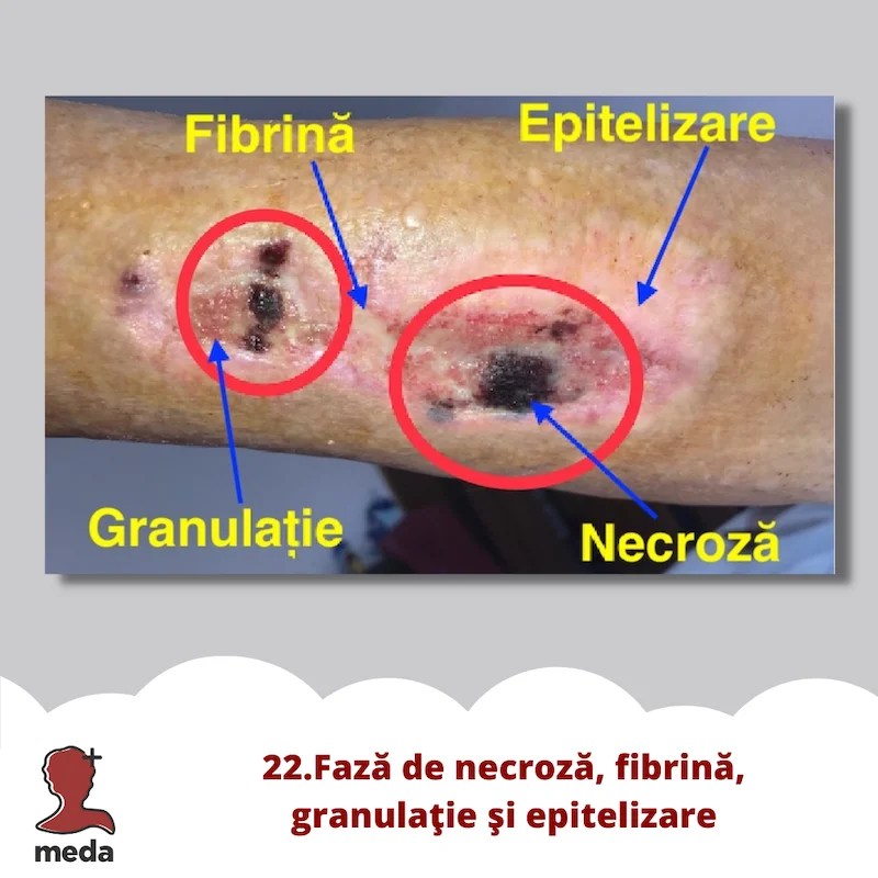 Cu ce se vindeca escarele 👉 tratarea ranilor ACASA  