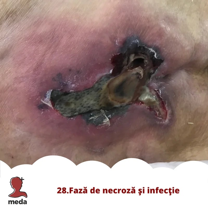Cu ce se vindeca escarele 👉 tratarea ranilor ACASA  