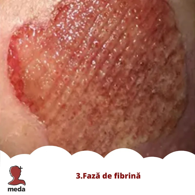 Cu ce se vindeca escarele 👉 tratarea ranilor ACASA  