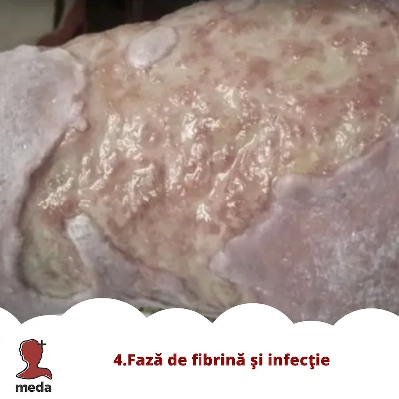 Cu ce se vindeca escarele 👉 tratarea ranilor ACASA  