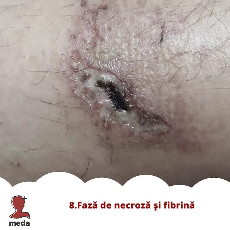 Cu ce se vindeca escarele 👉 tratarea ranilor ACASA  