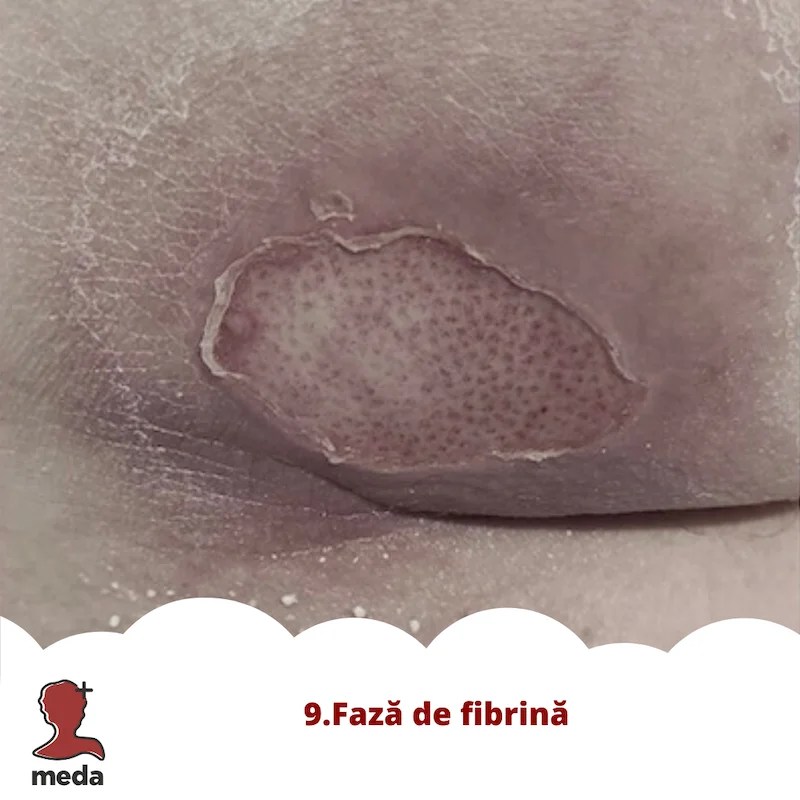 Cu ce se vindeca escarele 👉 tratarea ranilor ACASA  