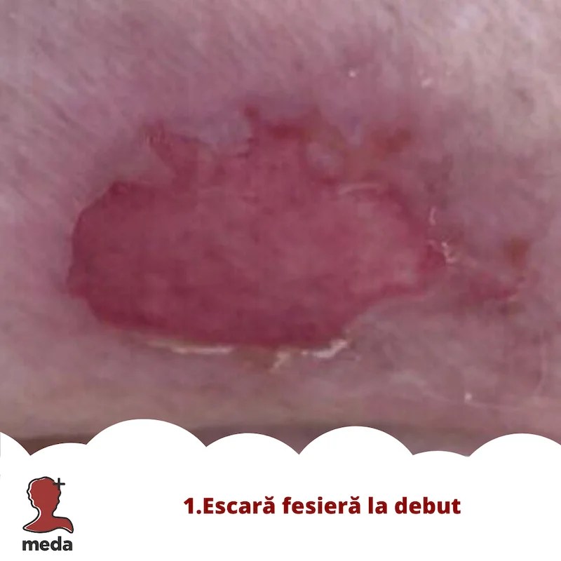 Cu ce se vindeca escarele 👉 tratarea ranilor ACASA  