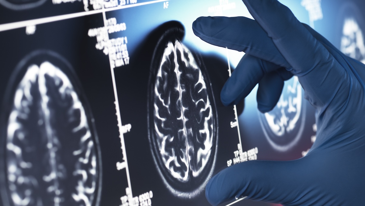 Dementia risk may be twice as high