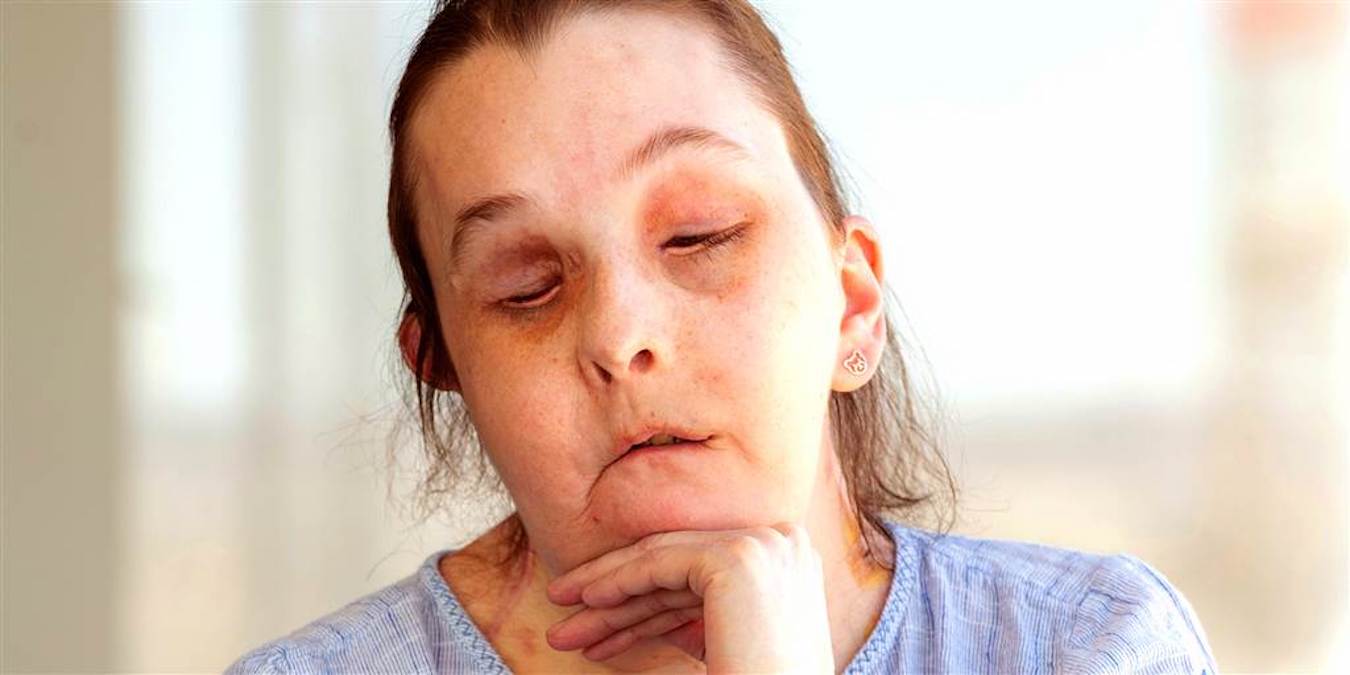 Domestic Abuse Survivor Became 1st Person to Undergo 2nd Face Transplant - Vimarsana News