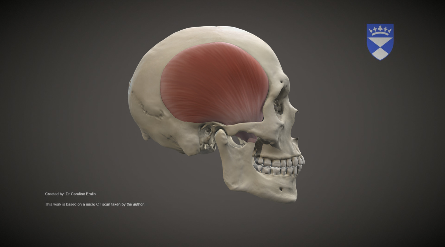 They are a group of muscles of the abdomen (belly) acting together forming a firm wall. Temporalis Muscles 3d Model By University Of Dundee Cahid Anatomy Dundee Bd32199