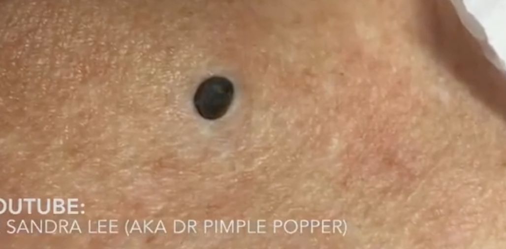 Dr. pimple popper -- the biggest blackhead in history!