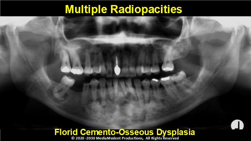 Cemental Dysplasia Radiology . Radiology Interpretation Diagnosis Medical Dental Education