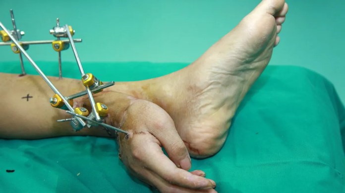 Did Chinese surgeon once save a patient’s severed hand by attaching it to his leg? What we know