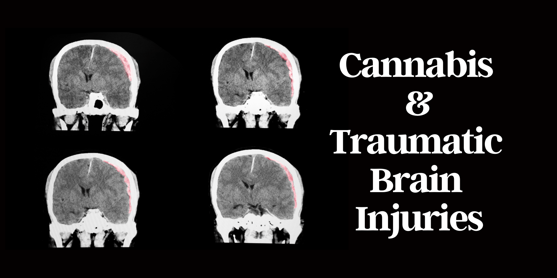 Cannabis for TBIs? How the Plant is Changing What We Know about ...