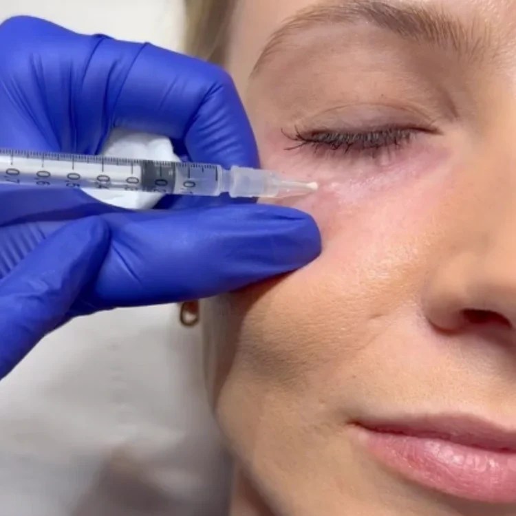 Polynucleotide Under Eye Treatment Brighten Your Eyes With This