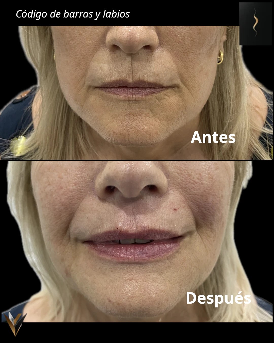 Tratamiento del código de barras y perfilado labial por Dr. Ariel Arias