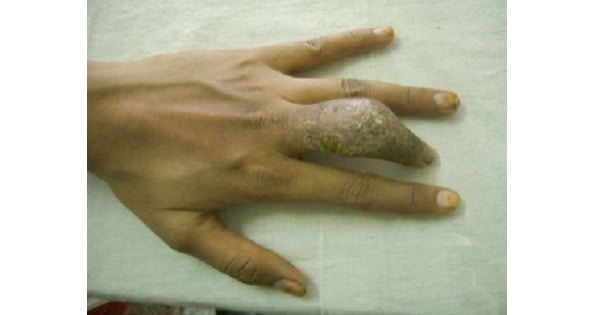 Skeletal Tuberculosis - www.medicoapps.org