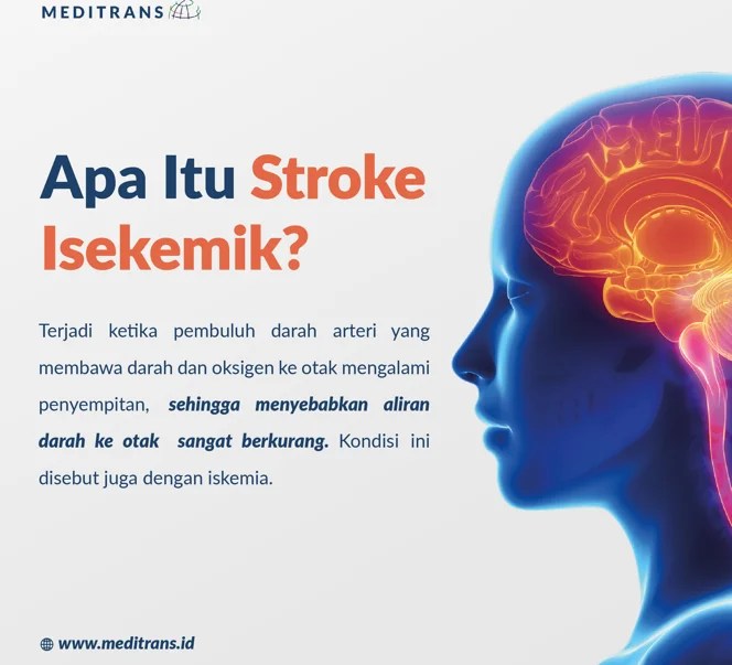 Apa Itu Stroke Iskemik ?