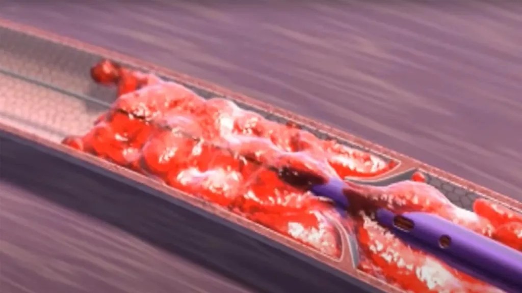 AngioJet™ Thrombectomy: Solusi Modern untuk Mengatasi Trombosis Pembuluh Darah