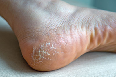 Frühe anzeichen einer schwangerschaft · übelkeit, flauer magen · erbrechen · müdigkeit, erschöpfung · spannungsgefühl in den brüsten · leicht erhöhte basaltemperatur . Keratoderma - Ursachen, Symptome & Behandlung | MedLexi.de