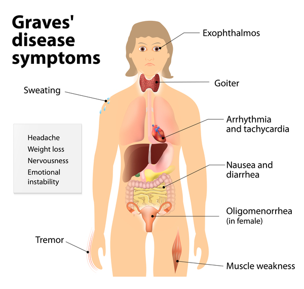 images Thyroid Symptoms In Men graves disease medlineplus genetics