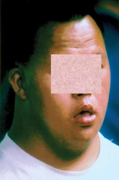 3m views 6 months ago. 3 M Syndrome Medlineplus Genetics