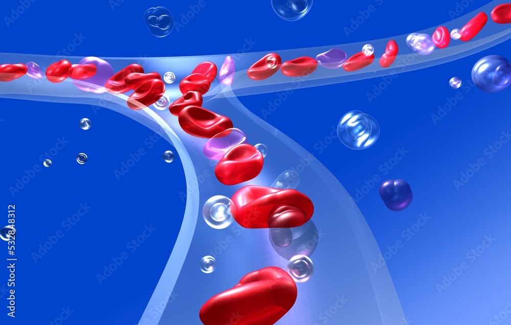 Myelodysplasia (MDS) is a bone marrow syndrome characterized by the presence of unhealthy (dysplastic) stem cells that displace the healthy ones, disrupting their ability to mature and develop properly. These healthy stem cells are responsible for generating essential components like red blood cells (which transport oxygen), white blood cells (crucial for fighting infections), and platelets (important for clotting). However, the unhealthy cells can suppress the function of the healthy ones, leading to various dysfunctions.