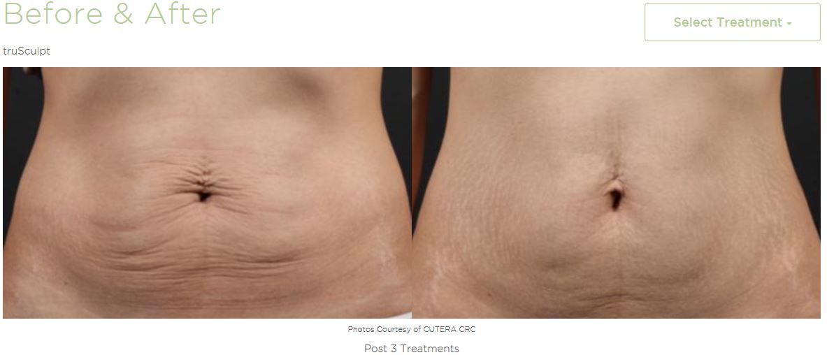 What is trusculpt 3d?