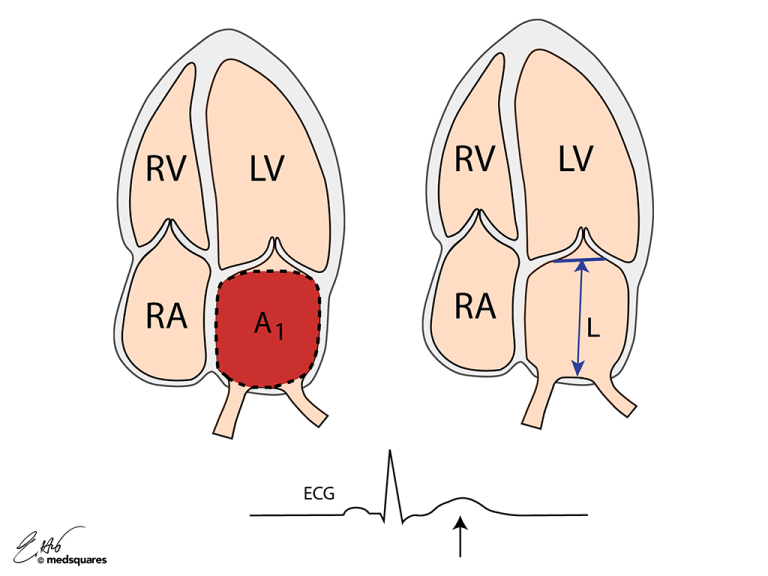 LA Volume (Biplane Method) Illustration 1