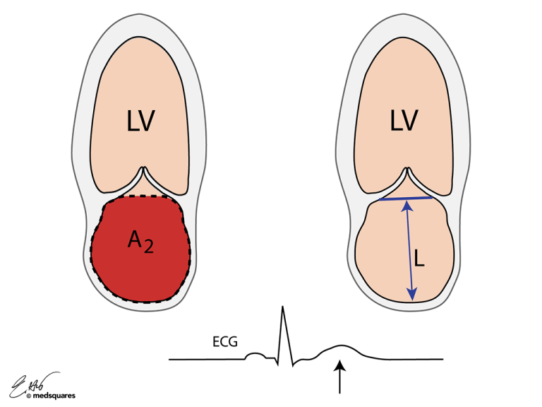 LA Volume (Biplane Method) Illustration 2