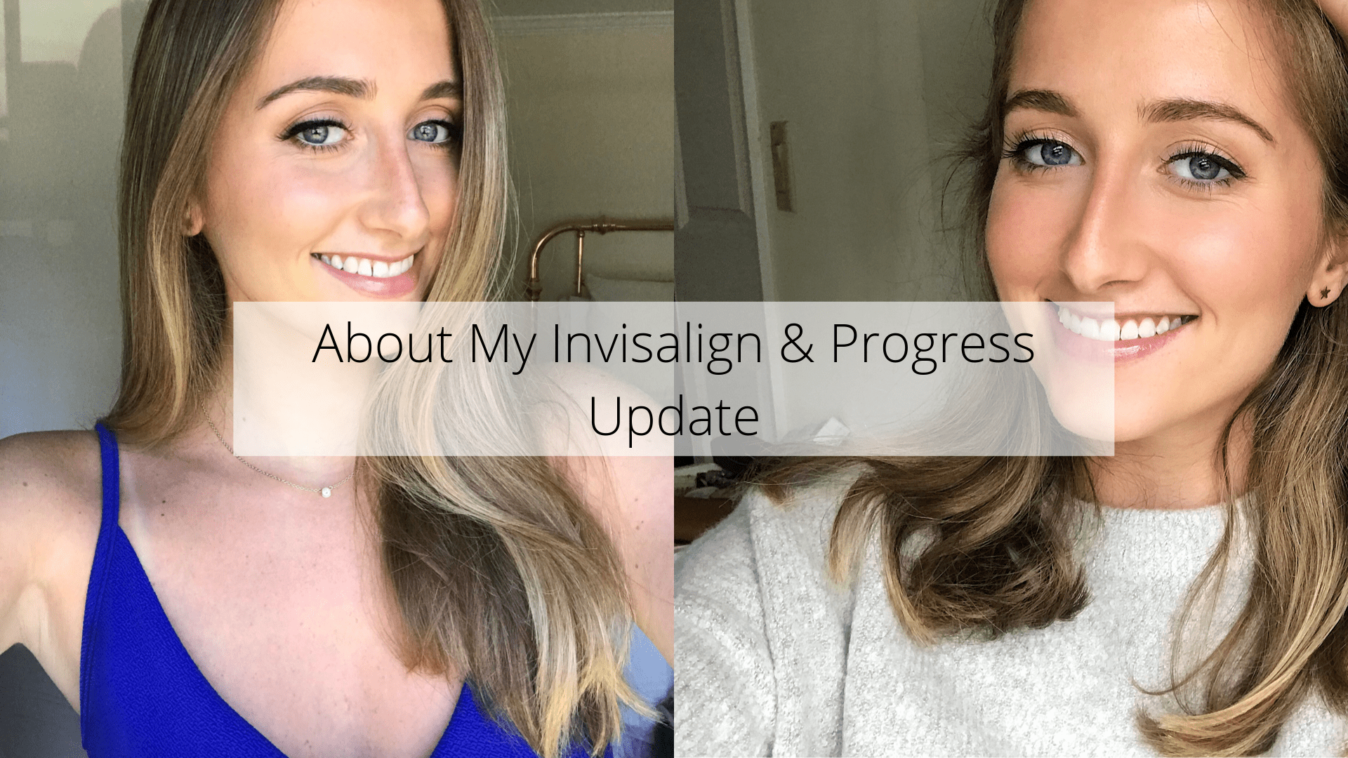 About My Invisalign & Progress Update