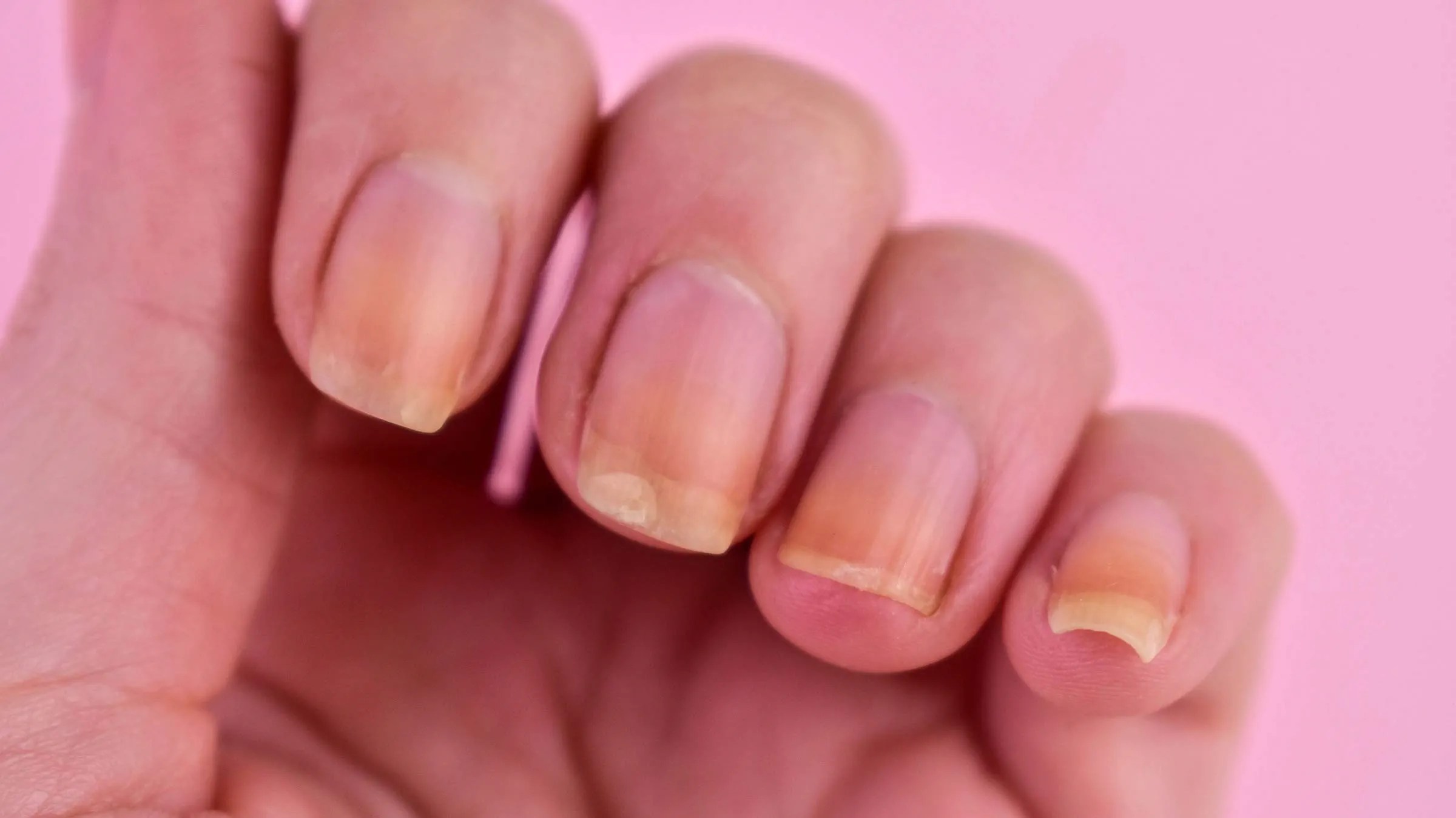 Yellow Nails
