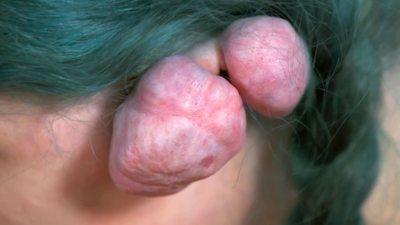 Jennifer má v hrudi odstraněny obrovské hrudky v první epizodě nové série ??? Dr. Pimple Popper ??????  29letá žena z Filadelfie řekla, jak začaly narůstat hrboly poté, co se jí před 11 lety infikovaly piercingy do uší.  Ona řekla:???  Jsou neuvěřitelně bolestivé a neuvěřitelně těžké.  Způsobují bolesti hlavy.  Mám strach, že se zvětší.  Bojím se, že budu zesměšňován a zesměšňován. ???  Cosplayer navštívil doktorku Sandru Lee poté, co jí ostatní lékaři nemohli pomoci.  Dr. Lee jí řekl, že trpí ??? extrémními keloidy ???  Během komplikované operace byla doktorka Lee nucena odstranit více ušní tkáně, než původně plánovala, a pomocí kožního štěpu přetvořila Jenniferino levé ucho.  Ona řekla:???  Jsou to pravděpodobně největší keloidy, jaké jsem kdy viděl.  Musel jsem sundat více ucha, než jsem čekal. ???  Po odstranění  čtyři keloidy vážily téměř 14 uncí.  Jennifer podstoupila radiační terapii, aby zabránila návratu keloidů.  Ona řekla:???  Všechno se změnilo k lepšímu.  Už žádné bolesti hlavy, už žádné závratě.  Nemusím se schovávat.  Dr. Lee mi dal budoucnost.  Docela mě zachránila. ???  ***** TNI Press Ltd nedrží ani neprosazuje žádná autorská práva nebo licence v přiloženém obrázku.  Veškeré poplatky placené společnosti TNI jsou pouze za služby TNI.  Takový poplatek nepředává ani nemá v úmyslu poskytnout uživateli žádná autorská práva nebo licence na obrázek.  Zveřejněním tohoto obrázku uživatel výslovně souhlasí s tím, že odškodní společnost TNI za jakékoli nároky, požadavky nebo příčiny jednání vyplývající z publikace obrázku uživatele nebo s ním jakýmkoli způsobem související.  Ona řekla:???  Všechno se změnilo k lepšímu.  Už žádné bolesti hlavy, už žádné závratě.  Nemusím se schovávat.  Dr. Lee mi dal budoucnost.  Docela mě zachránila. ???  ***** TNI Press Ltd nedrží ani neprosazuje žádná autorská práva nebo licence v přiloženém obrázku.  Veškeré poplatky placené společnosti TNI jsou pouze za služby TNI.  Takový poplatek nepředává a ani nemá v úmyslu poskytnout uživateli žádná autorská práva nebo licence na obrázek.  Zveřejněním tohoto obrázku uživatel výslovně souhlasí s tím, že odškodní společnost TNI za jakékoli nároky, požadavky nebo příčiny jednání vyplývající z publikace obrázku uživatele nebo s ním jakýmkoli způsobem související.  Ona řekla:???  Všechno se změnilo k lepšímu.  Už žádné bolesti hlavy, už žádné závratě.  Nemusím se schovávat.  Dr. Lee mi dal budoucnost.  Docela mě zachránila. ???  ***** TNI Press Ltd nedrží ani neprosazuje žádná autorská práva nebo licence v přiloženém obrázku.  Veškeré poplatky placené společnosti TNI jsou pouze za služby TNI.  Takový poplatek nepředává a ani nemá v úmyslu poskytnout uživateli žádná autorská práva nebo licence na obrázek.  Zveřejněním tohoto obrázku uživatel výslovně souhlasí s tím, že odškodní společnost TNI za jakékoli nároky, požadavky nebo příčiny jednání vyplývající z publikace obrázku uživatelem nebo jakýmkoli způsobem spojená s jeho zveřejněním.  ???  ***** TNI Press Ltd nedrží ani neprosazuje žádná autorská práva nebo licence v přiloženém obrázku.  Veškeré poplatky placené společnosti TNI jsou pouze za služby TNI.  Takový poplatek nepředává ani nemá v úmyslu poskytnout uživateli žádná autorská práva nebo licence na obrázek.  Zveřejněním tohoto obrázku uživatel výslovně souhlasí s tím, že odškodní společnost TNI za jakékoli nároky, požadavky nebo příčiny jednání vyplývající z publikace obrázku uživatele nebo s ním jakýmkoli způsobem související.  ???  ***** TNI Press Ltd nedrží ani neprosazuje žádná autorská práva nebo licence v přiloženém obrázku.  Veškeré poplatky placené společnosti TNI jsou pouze za služby TNI.  Takový poplatek nepředává a ani nemá v úmyslu poskytnout uživateli žádná autorská práva nebo licence na obrázek.  Zveřejněním tohoto obrázku uživatel výslovně souhlasí s tím, že odškodní společnost TNI za jakékoli nároky, požadavky nebo příčiny jednání vyplývající z publikace obrázku uživatele nebo s ním jakýmkoli způsobem související.