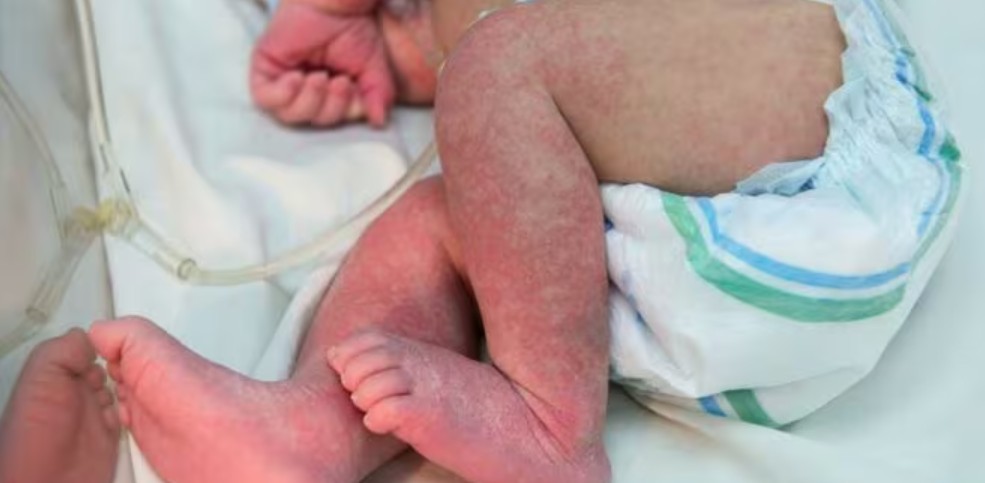 Bebê de 48 dias morre por chikungunya e Dourados registra 10ª morte pela doença