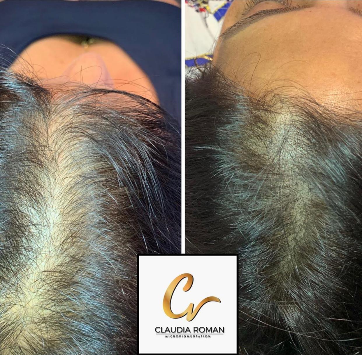 Scalp micropigmentation