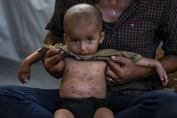 جدري الماء يفتك بأطفال غزة
