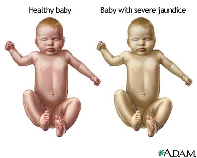 Hemolytic disease of the newborn - hemolytic disease of the newborn Hemolytic disease of the newborn - hemolytic disease of the newborn