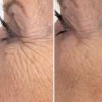 Anti wrinkle treatment delivered by the matrix pro micro needle rf machine