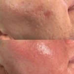 Pre and post treatment of collagen stimulation - Laze&Amaze experience