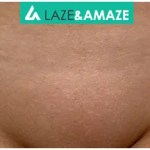 diode laser hair removal machine