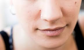 Facial Wrinkles