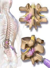 Facet Joint Syndrome