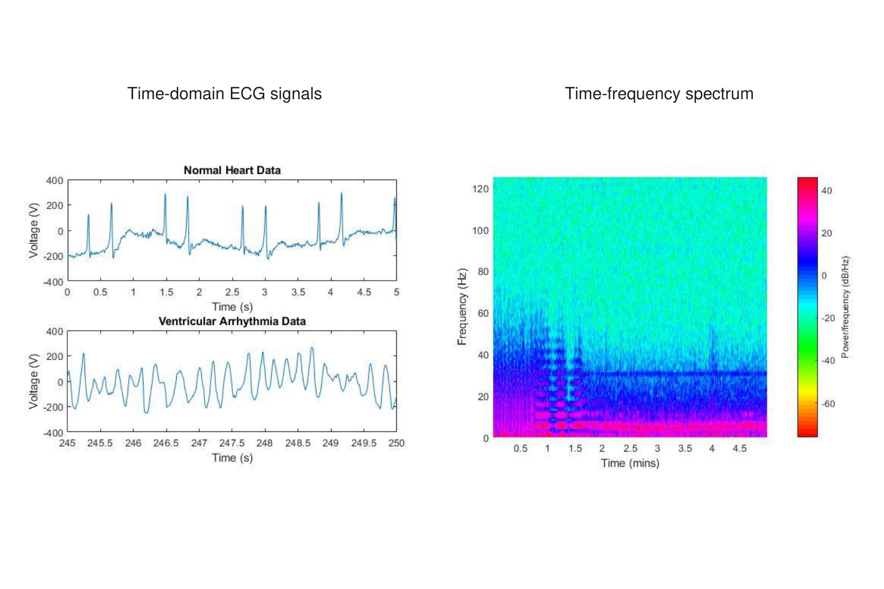 Complete normal and ventricular-arrhythmia ECG time plots beside a spectrogram, preserving all time axes, frequency axis and color scale.