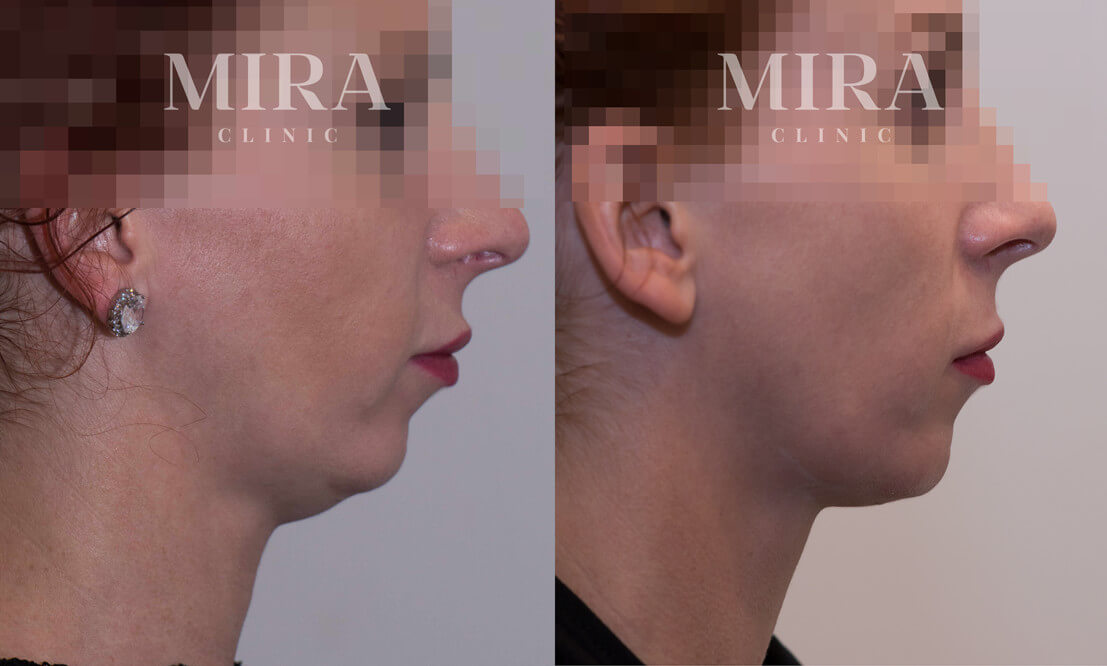 pix Fat Dissolving Injection progress report on double chin dissolving injections mira clinic