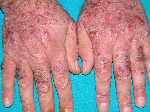 Mengenali Penyakit Eksim Basah. Apa itu eksim basah? | by Obat Gatal Kulit dan Kelamin De Nature | Medium