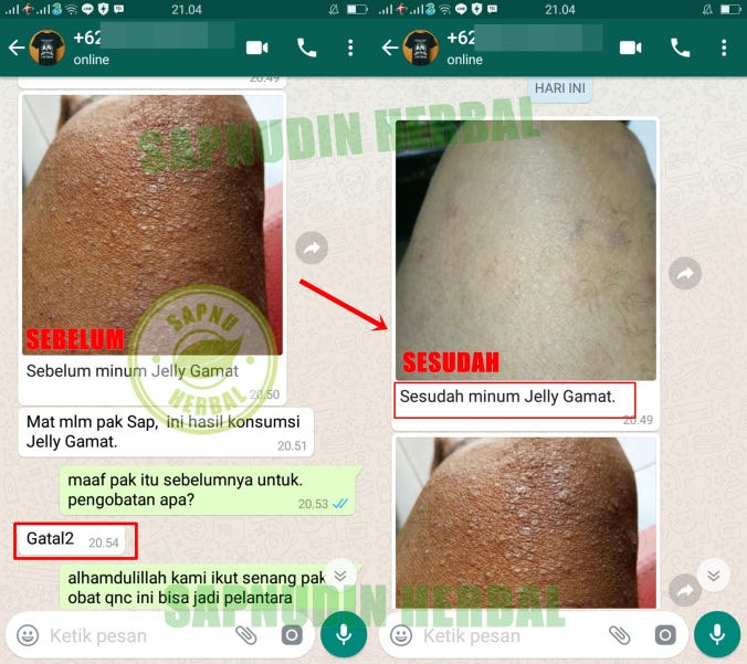 Pengobatan Dan Gambar Penyakit Kudis Atau Gudik Gudik Scabies