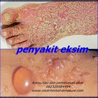 Cara Mengobati Penyakit Gatal Menahun Dengan Obat Denature