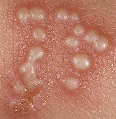 Cara Mengobati Herpes Pada Bayi Cara Alami Mengobati Wasir