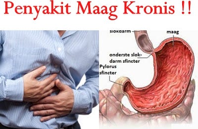 Obat Maag Kronis Menahun Alami Dari Ramuan Tradisional