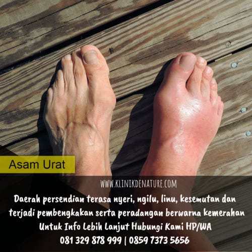Cara Menghilangkan Asam Urat Secara Alami Andrea Taulanie Medium
