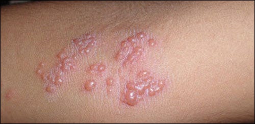 Nama Lain Penyakit Herpes. Nama Lain Penyakit Herpes — Pernahkah… | by Penyakit  Herpes | Medium