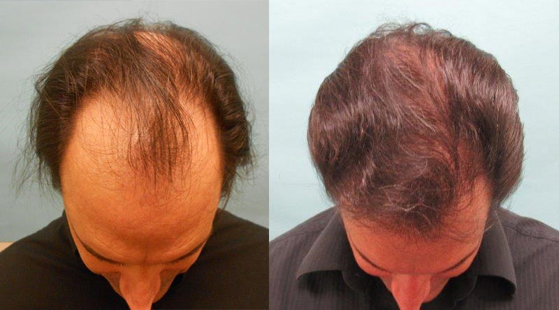 How does an amazing 3000 grafts hair transplant change your life?
