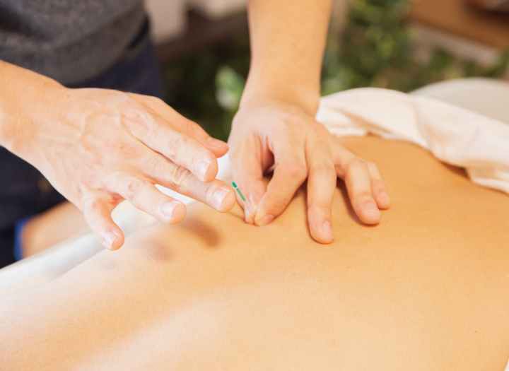 therapist treating patient with needles during procedure of alternative medicine