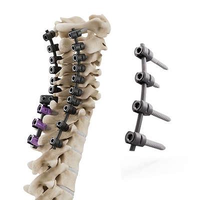 icotec's CMORE® CT System is a posterior cervicothoracic implant system designed to support spinal stabilization while enabling visualization for postoperative assessment 
